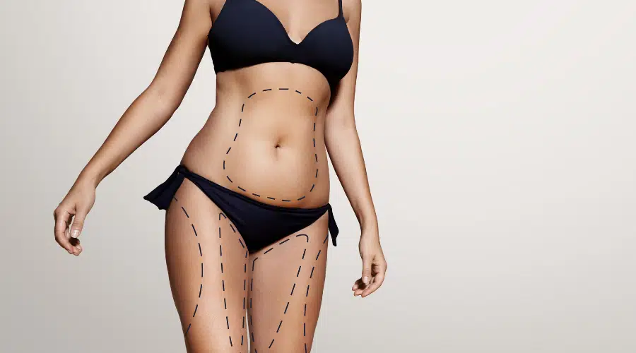 How Much Does Traditional Liposuction Cost?