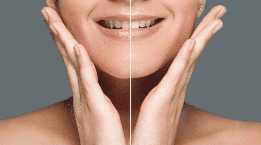 What is the cost of teeth whitening?