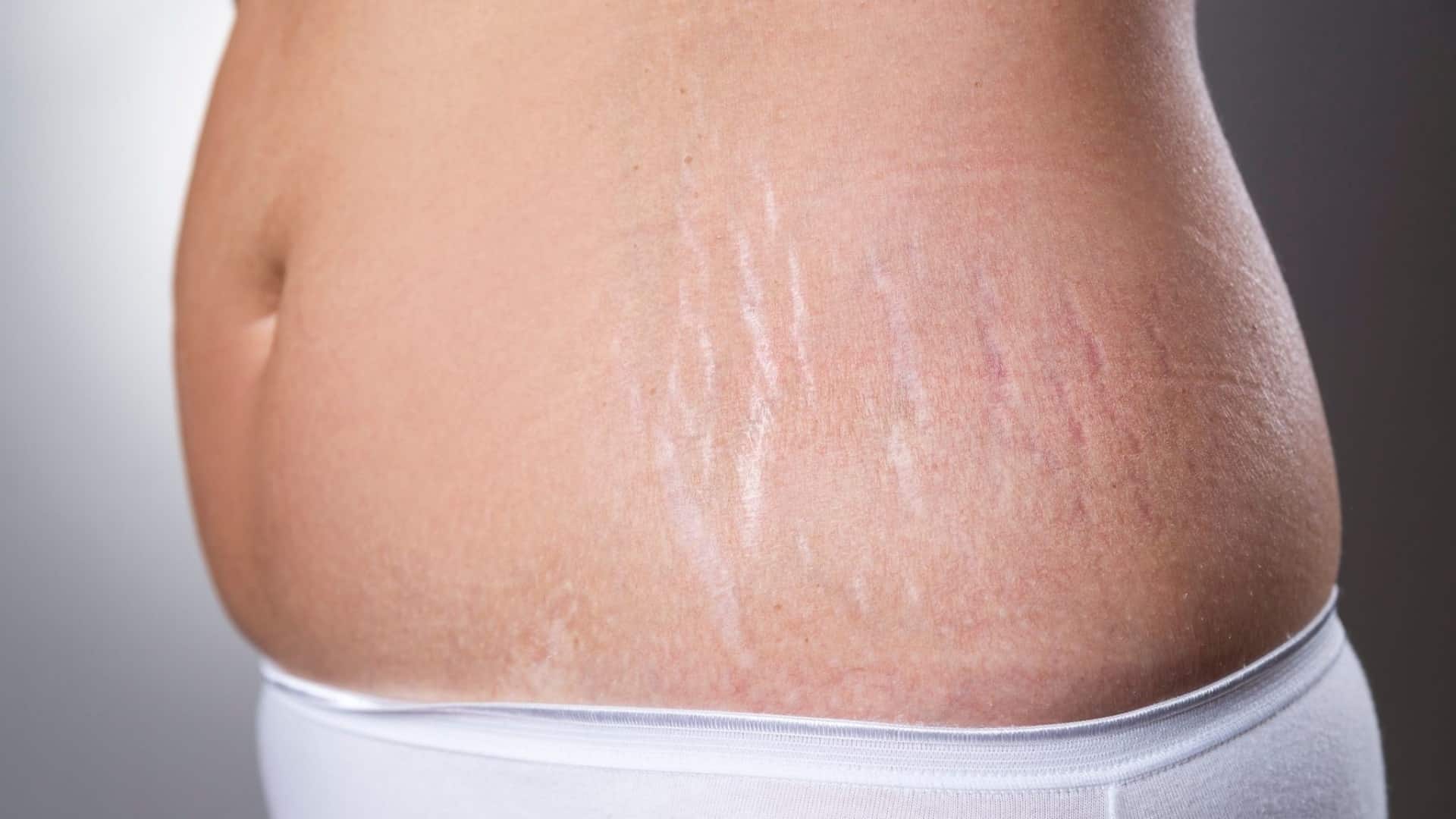13 Celebrities With Stretch Marks From Pregnancy