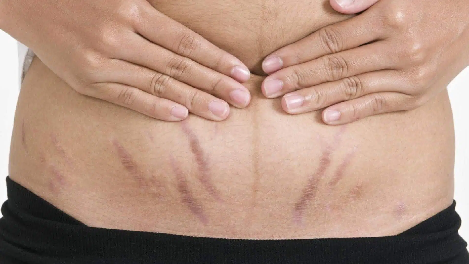 Purple Stretch Marks: Can You Get Rid of Them?