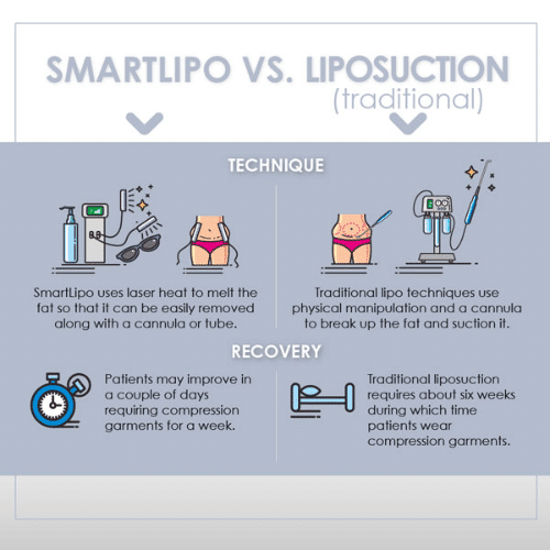 SmartLipo vs Lipo